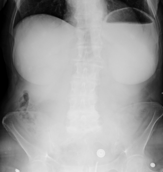 Abdomen Röntgen bei Bauchschmerz unauffällig trotz Ileus