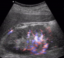 Ultrasound of the Kidney