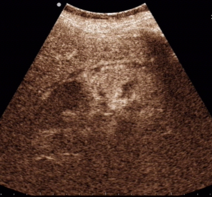 CEUS of the right kidney