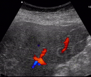Duplexsonografie der Leberläsion, Ultrasound epitheloid hemangioendothelioma