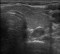 primärer Hyperparathyreoidismus im Ultraschall