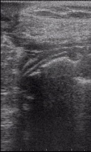 sonographic aspect of normal PEG-Tube
