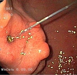 Endoscopic aspect of Buried bumper syndrome