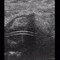 Epigastric ultrasound in hemiplegic patient with pneumonia