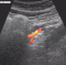 dopplersonografischer Ultraschall der intraabdominellen Gefäße