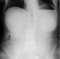 Röntgen Abdomen, Ileus im Ultraschall