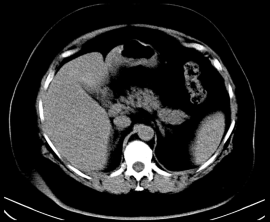 computed tomography does not detect the tumor seen on ultrasound