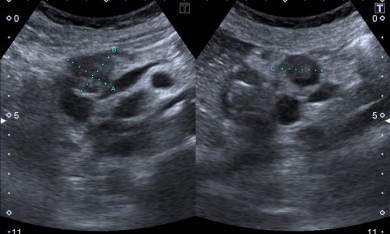 Intraductal Papillary Mucinous Neoplasia (IPMN) of the Pancreas