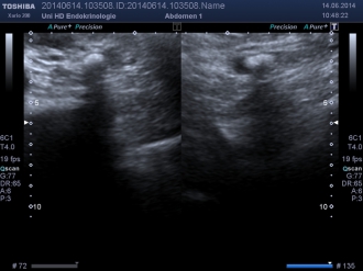 Ultraschall: Harnleiterstein links mit Nierenstauung