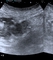 acute onset abdominal pain, right lower quadrant