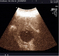 abdominal pain with tenderness in ultrasound imaging