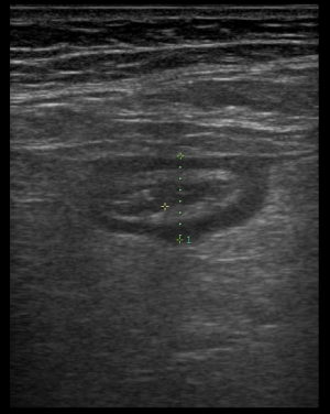 pseudomembranöse Colitis