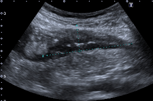 Stenose bei M. Crohn