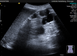 cystic degeneration of a pancreas in von Hippel-Lindau-Syndrome