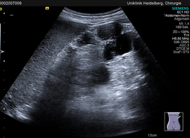 cystic degeneration of a pancreas in von Hippel-Lindau-Syndrome