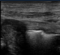bowel ultrasound, Darmultraschall