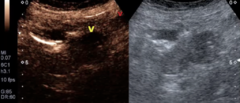 contrast enhanced ultrasound in colonic cancer